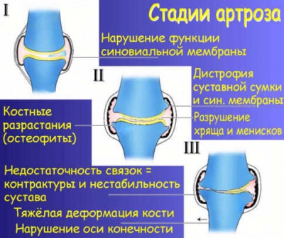 Описание: Стадии артроза