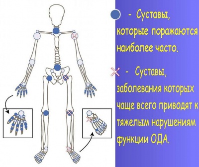 Описание: Наиболее частое поражение суставов при остеоартрозе