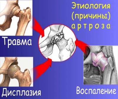 Описание: Наиболее частые причины вторичного остеоартроза
